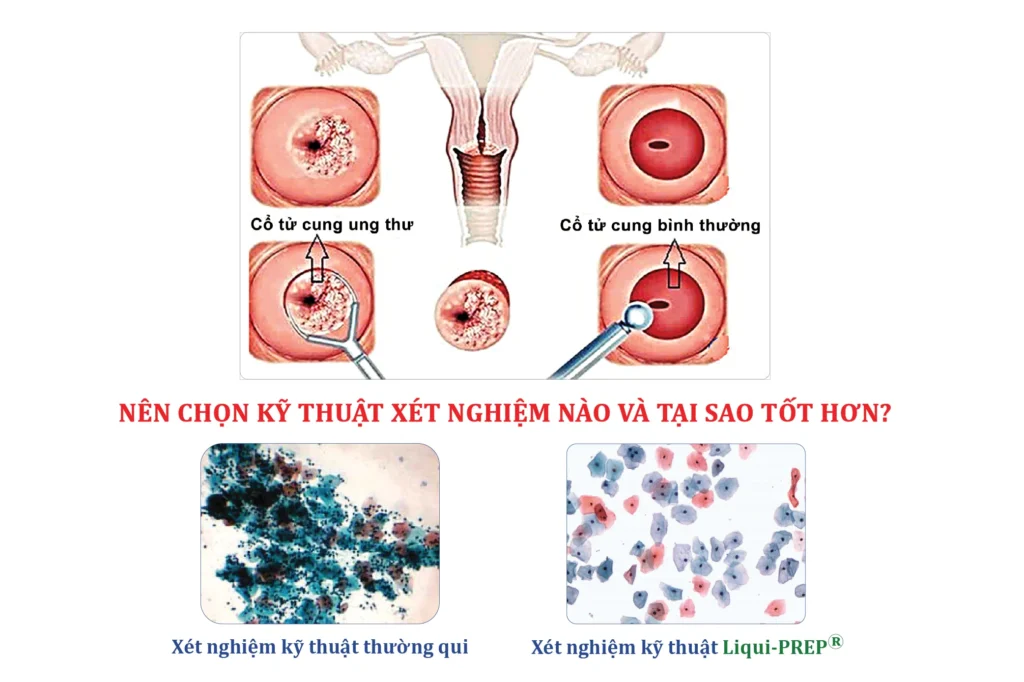 tam-soat-ung-thu-co-tu-cung