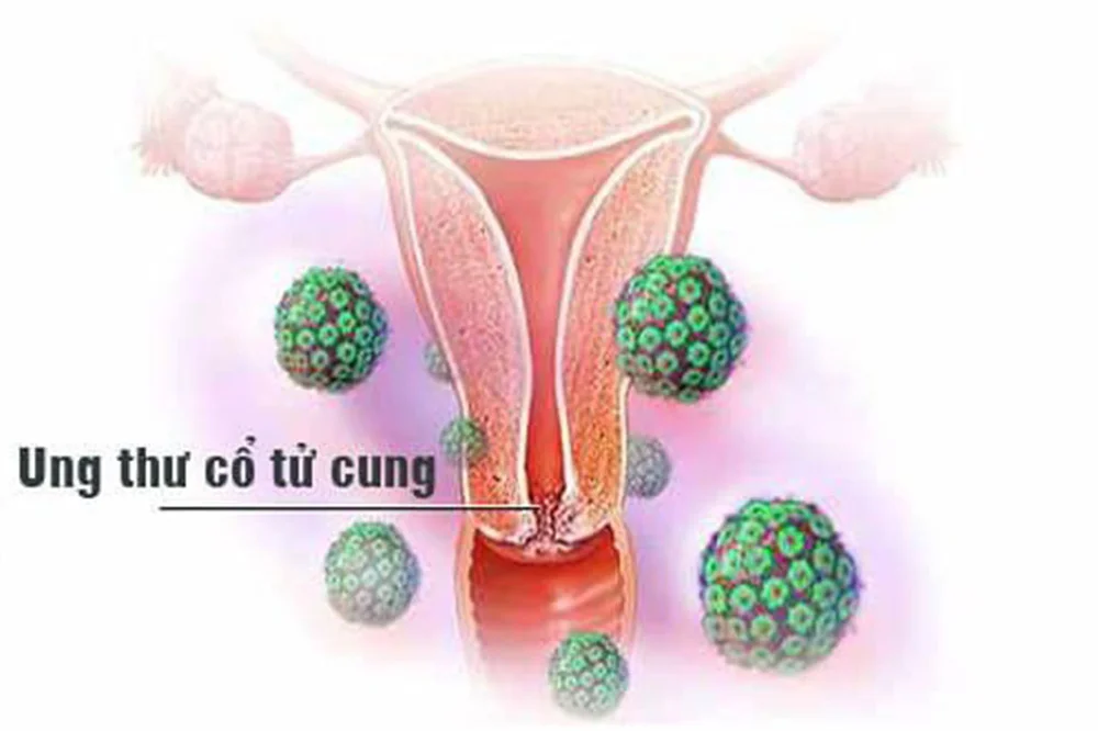 medpadiag-tam-soat-ung-thu-co-tu-cung-dinh-ky