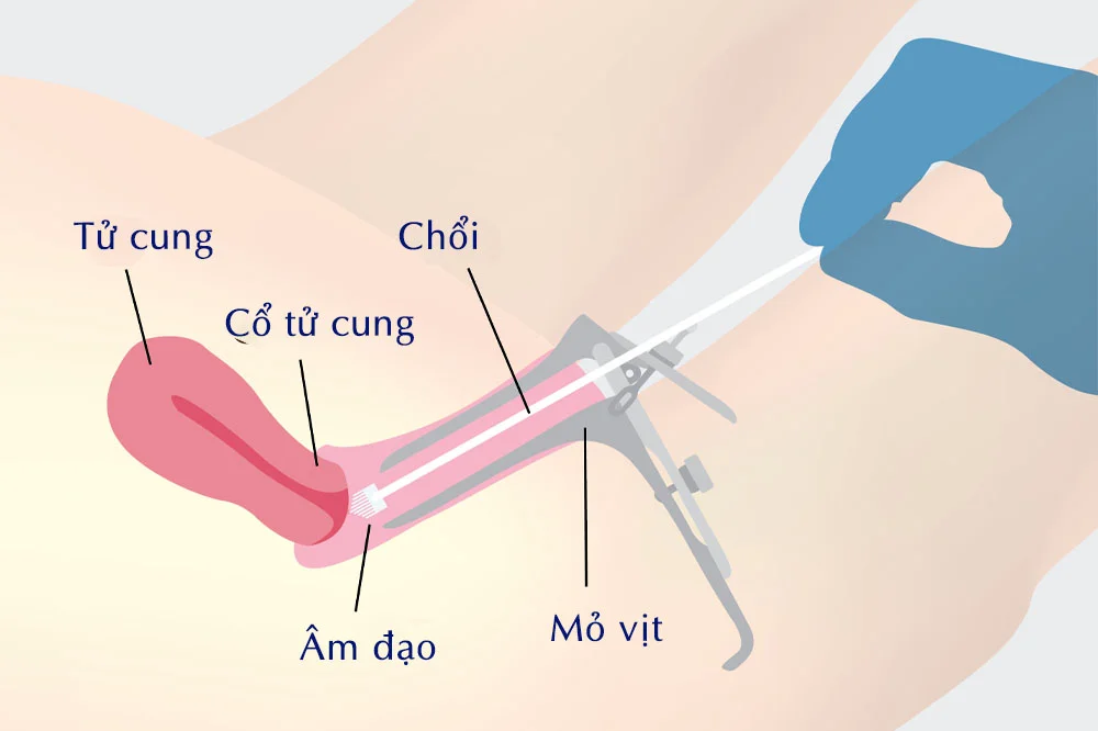 medpadiag-xet-nghiem-hpv-genotype
