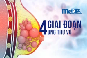 medpadiag-cac-giai-doan-ung-thu-vu