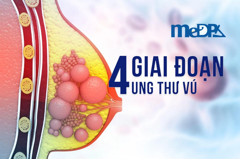 medpadiag-cac-giai-doan-ung-thu-vu