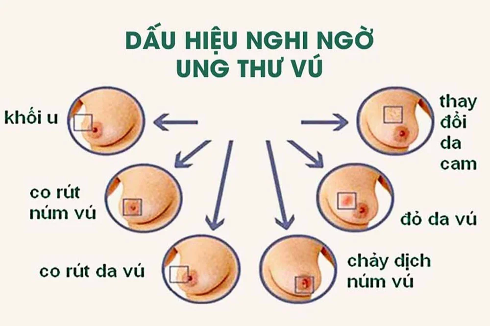 medpadiag-cac-giai-doan-ung-thu-vu