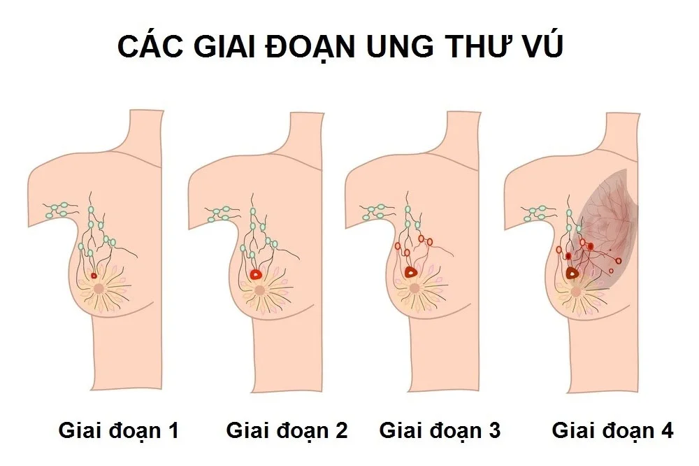 medpadiag-cac-giai-doan-ung-thu-vu