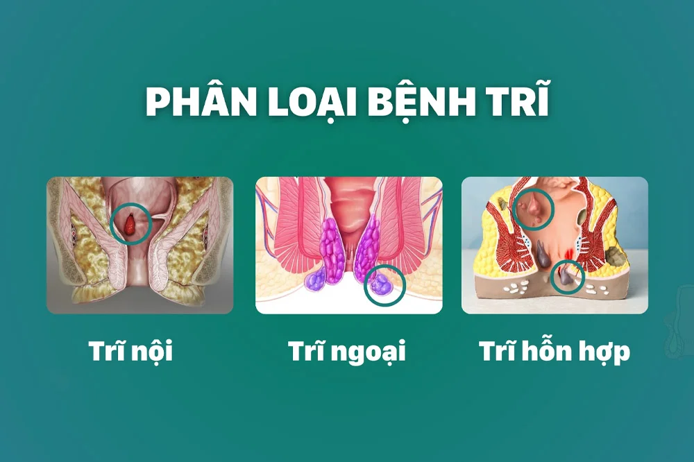 medpadiag-benh-tri-nguyen-nhan-bieu-hien