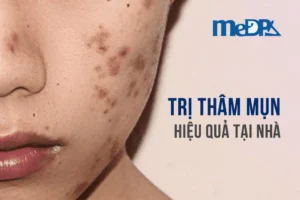 medpadiag-tri-tham-mun-hieu-qua-tai-nha