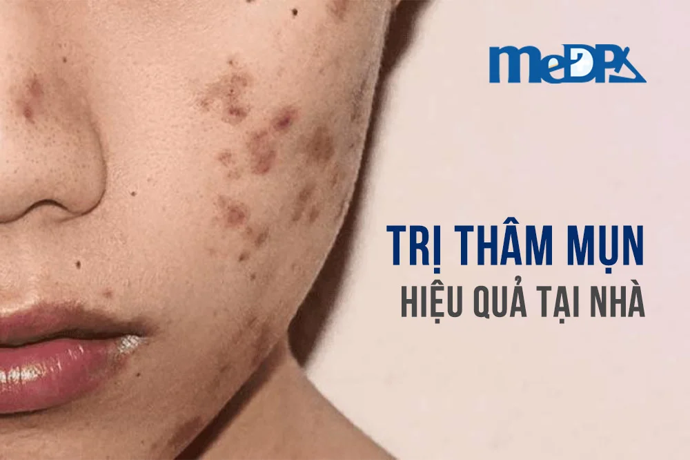 medpadiag-tri-tham-mun-hieu-qua-tai-nha