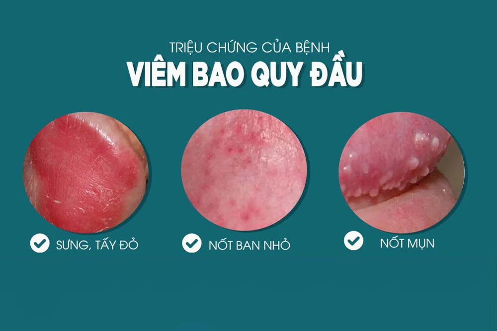 medpadiag-viem-bao-quy-dau