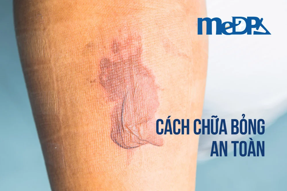 medpadiag-cach-chua-bong-an-toan