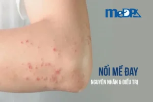 medpadiag-noi-me-day-nguyen-nhan-cach-dieu-tri