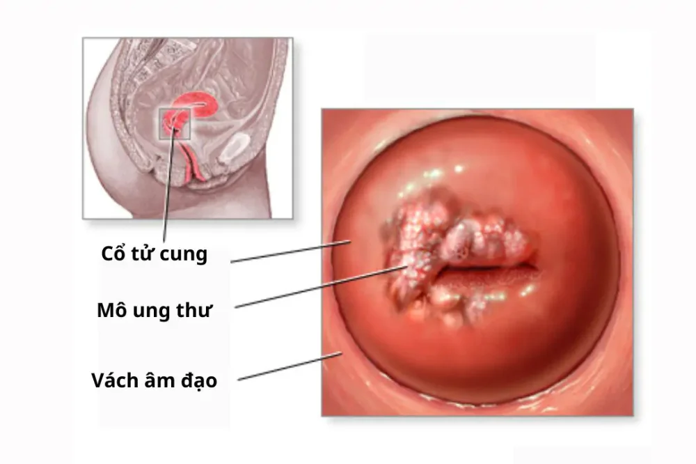 medpadiag-hpv-la-gi-xet-nghiem-hpv