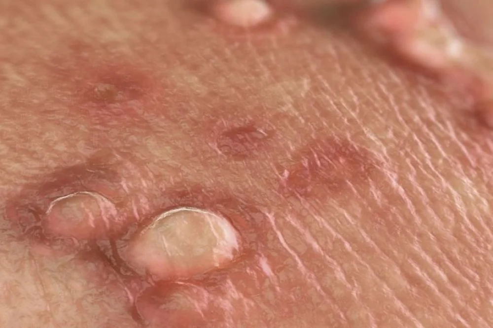 medpadiag-hpv-la-gi-xet-nghiem-hpv