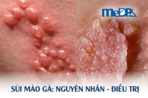 medpadiag-sui-mao-ga-nguyen-nhan-dieu-tri