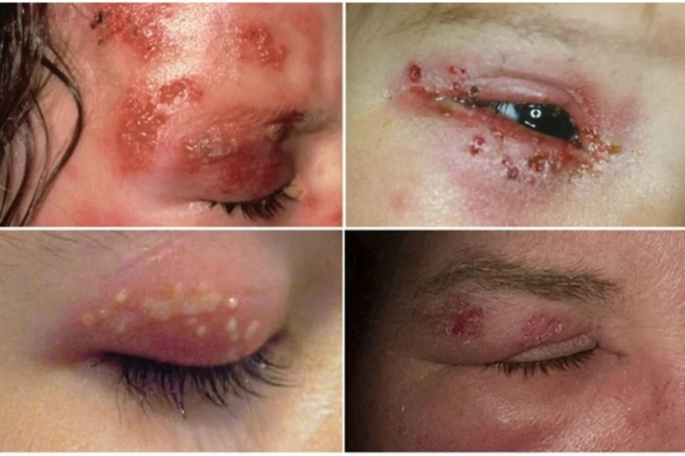 medpadiag-zona-than-kinh-cach-dieu-tri