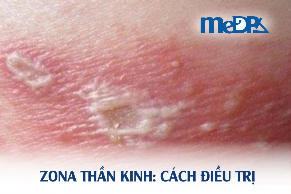 medpadiag-zona-than-kinh-cach-dieu-tri
