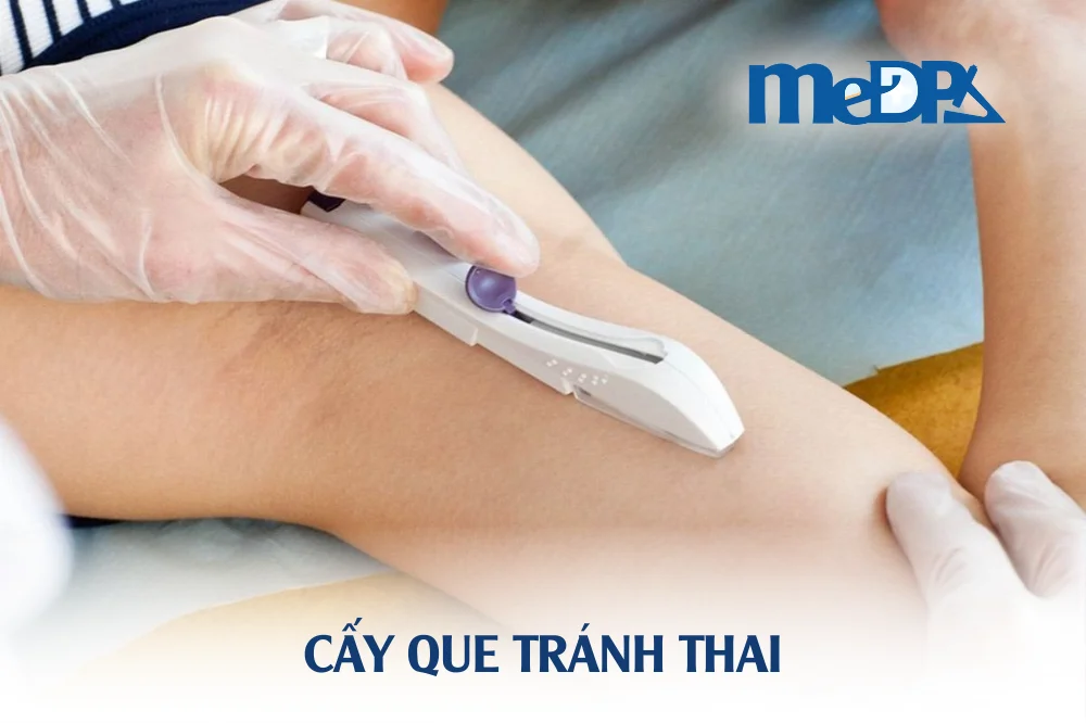 medpadiag-cay-que-tranh-thai