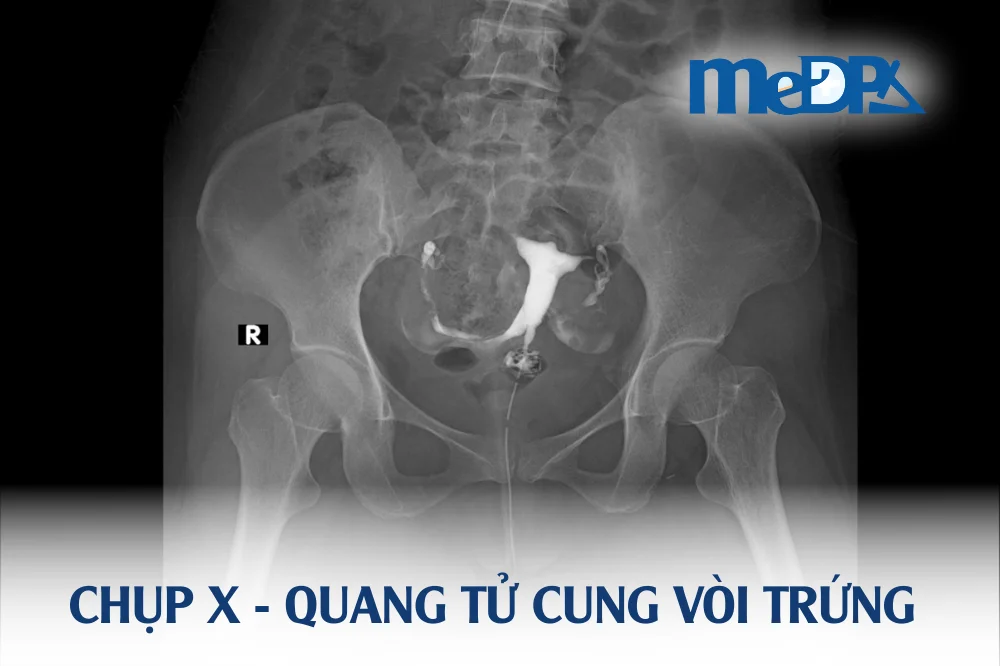 medpadiag-chup-voi-trung-co-tu-cung