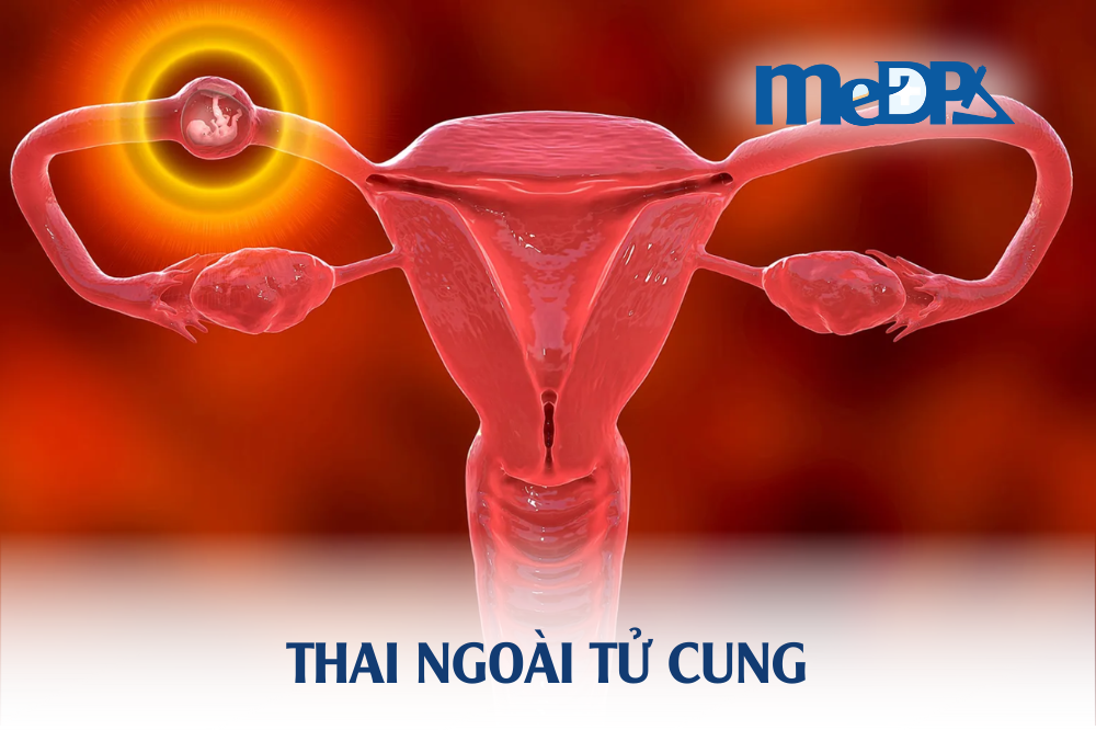 medpadiag-thai-ngoai-tu-cung-la-gi