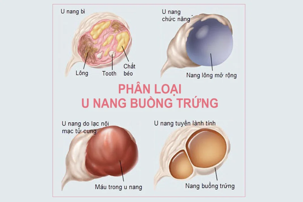 medpadiag-u-nang-buong-trung-la-gi