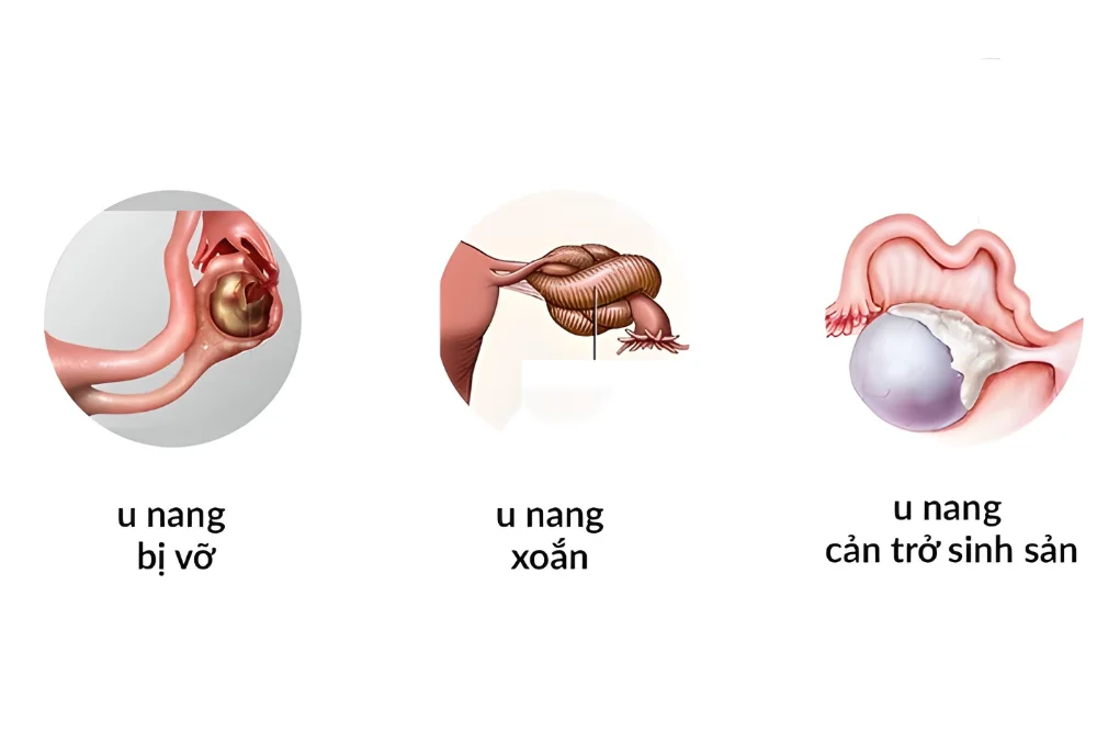 medpadiag-u-nang-buong-trung-la-gi