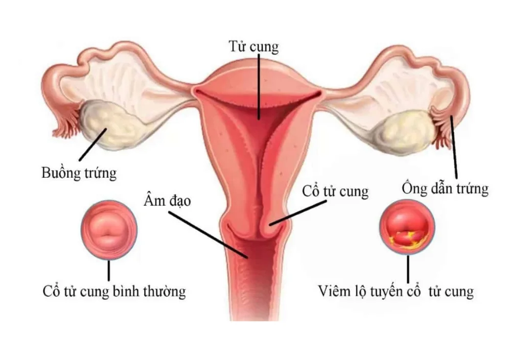 medpadiag-viem-lo-tuyen-co-tu-cung