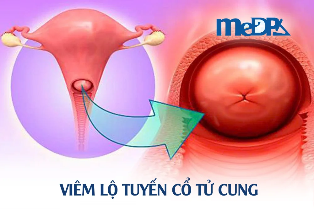 medpadiag-viem-lo-tuyen-co-tu-cung