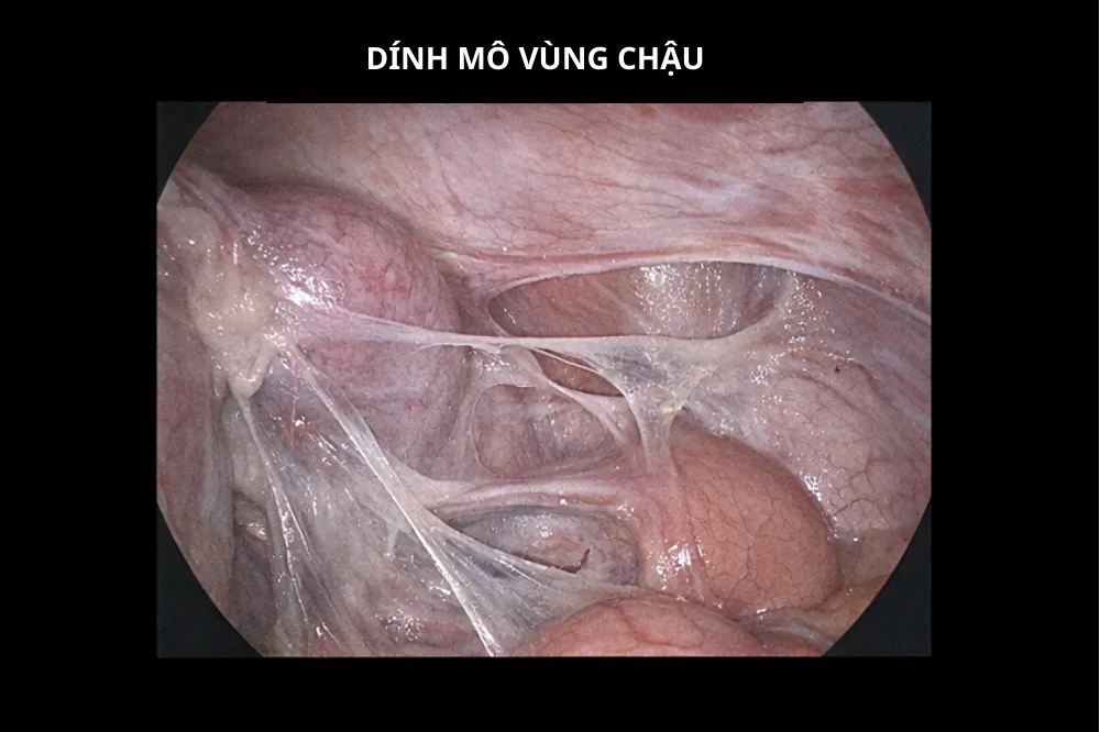 medpadiag-lac-noi-mac-tu-cung-dinh-mo-vung-chau